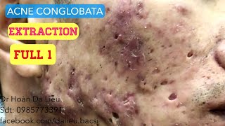 Mụn trứng cá mạch lươnDermatologist pimpleswhitehead blackhead acne conglobata extraction full [upl. by Epilef800]