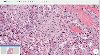 Medullary Carcinoma  Thyroid Gland Histopathology [upl. by Leoni]