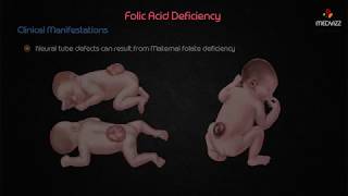 Folic Acid deficiency  USMLE Biochemistry [upl. by Countess]