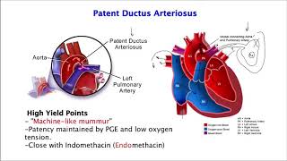 Heart SoundsPatent Ductus Arteriosus [upl. by Nabla]