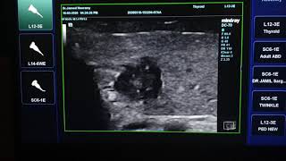 Papillary Thyroid Cancer Ultrasound [upl. by Larrie]