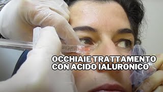 Occhiaie Trattamento con Acido Ialuronico [upl. by Ayrolg407]