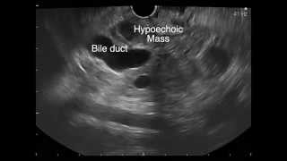 Endoscopic ultrasound FNA of a pancreatic mass [upl. by Mccallum714]