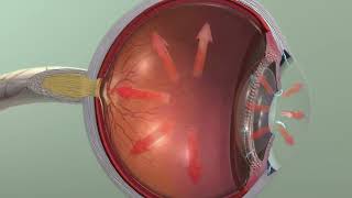 Animation Glaucoma [upl. by Natassia]