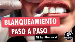 🦷😁 Blanqueamiento dental PASO A PASO 😁🦷 Antes y después  Clínica Dental Dentisalut [upl. by Chrystal]